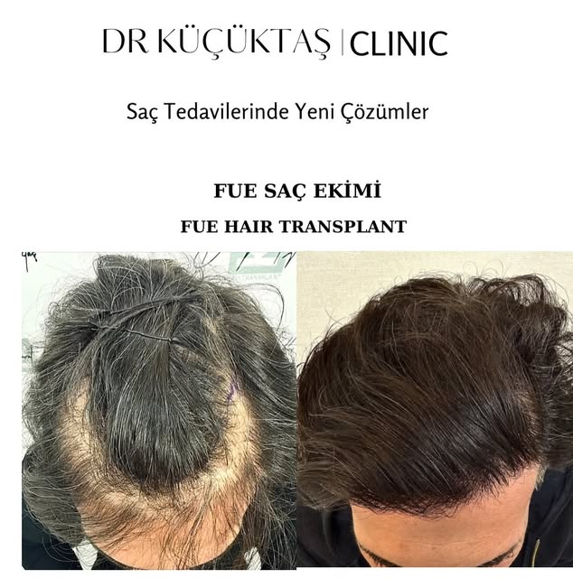 Her saç ekiminde hedef, mümkün olan en fazla saçı ekmek değildir. Asıl hedef, doğal ve yüzle uyumlu 