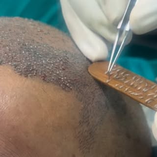 Does Transplanted hair last long???

Those who want to undergo hair transplant are worried that new 