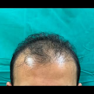 Mega session FUE Hair transplant 3700 grafts over 6 hrs surgery under local anaesthesia as day care 