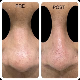 *Liquid Rhinoplasty* = "Non-surgical nose job"
Its filler used to reshape the nose without cutting. 