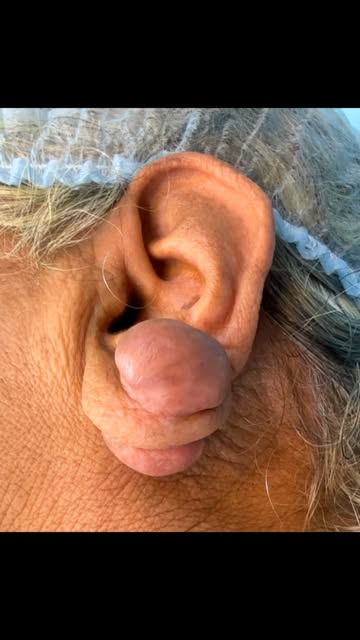 Dumbbell-shaped ear keloid is a very #revivelasercentre ommon type of keloid, especially after ear p