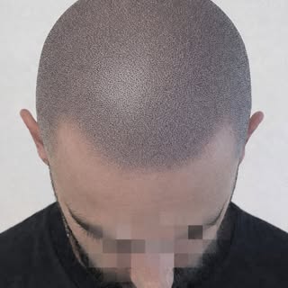 TRICOPIGMENTAZIONE COME RICHIESTA DAL CLIENTE.

Nascondi la calvizie con la 𝐓𝐫𝐢𝐜𝐨𝐩𝐢𝐠𝐦𝐞𝐧𝐭