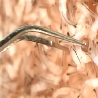 #besthairtransplant #Dhihair transplant #fue hairtransplant