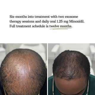 6-month progress check.

So far, Ebeneezer has:

✔️Completed a trichology consultation via Zoom
✔️Ha