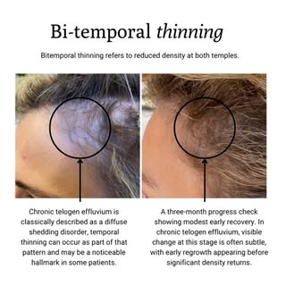 No minoxidil, no injections, just diet and lifestyle changes with the support of a Trichologist. 🕺�