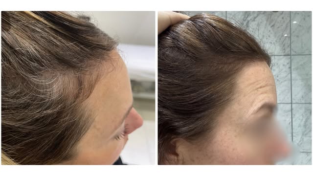 An increase in viable hair density can be one of the first signs that a treatment strategy is moving