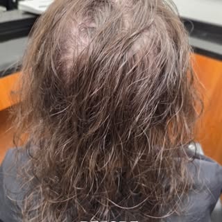 Hair loss can feel very personal — especially when thinning becomes harder to cover or style.

For m