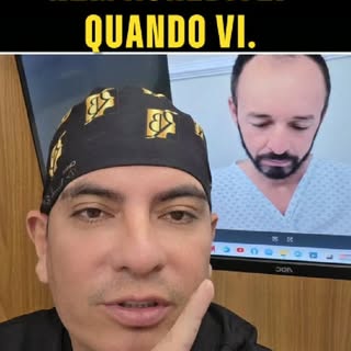 6 meses. Uma nova imagem.
O resultado desse paciente aos 6 meses mostra o que um transplante capilar
