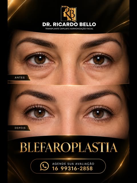 ✨ BLEFAROPLASTIA: UM OLHAR MAIS JOVEM E HARMÔNICO
Com o passar dos anos, o excesso de pele e as bols