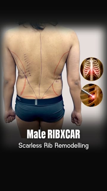 Scarless Rib Remodelling (RIBXCAR): The Modern Approach to a Curved Waist

A thin waist is not alway