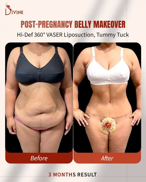 Post-Pregnancy Belly Makeover | Beach-Ready Hourglass Snatched Figure 

Mommy Makeover: Hi-Def 360° 