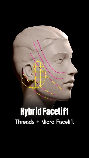 When Threads Alone Aren’t Enough — The Hybrid Facelift

A facelift doesn’t have to mean a major surg