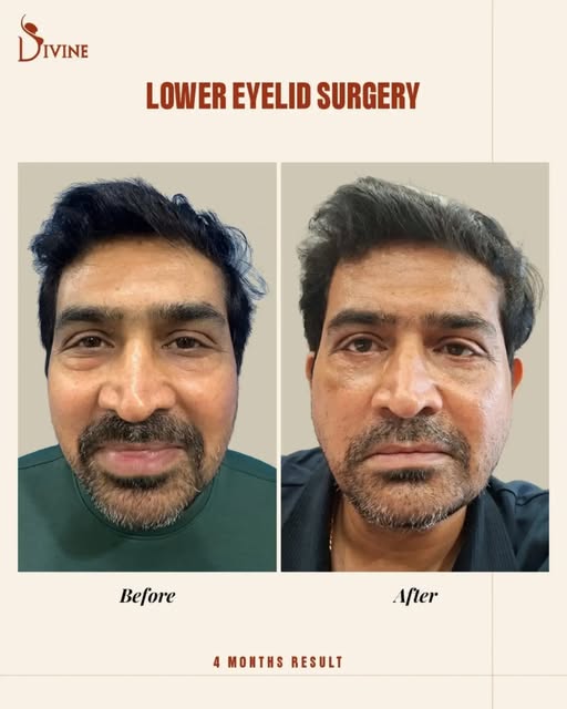 Lower Eyelid Surgery in Delhi | 4-Month Natural Results

Tired-looking eyes aren't always caused by 