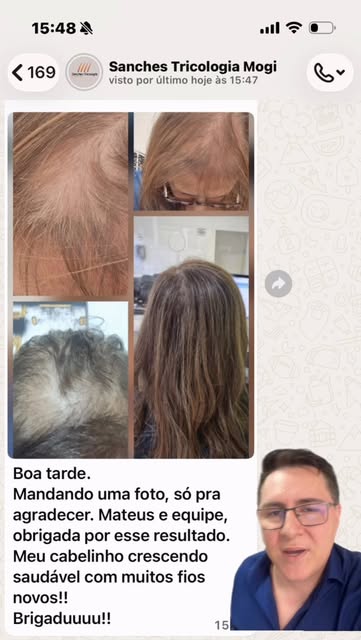 Quando o paciente percebe a transformação ❤️

“Meu cabelinho crescendo saudável, com muitos fios nov