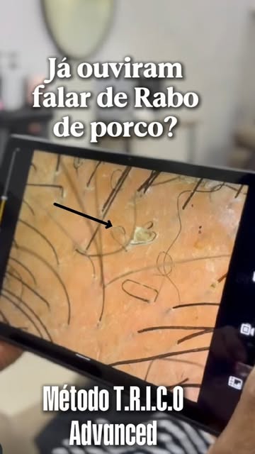 Você já ouviu falar no famoso “rabo de porco”? 

Nesse caso, a paciente tinha o hábito de lavar o ca