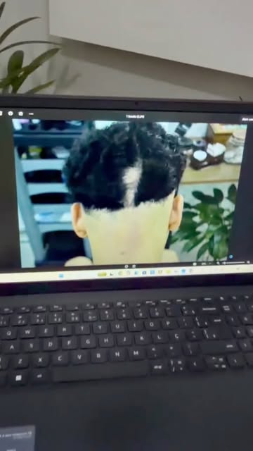 Alopecia areata vai muito além da queda de cabelo. É uma condição autoimune que exige diagnóstico pr