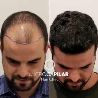 Cirugía de Injerto Capilar de máxima extracción folicular con Técnica FUE Zafiro HD en Microcapilar 