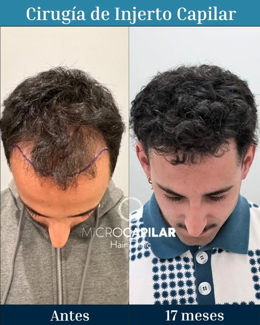Resultados estupendos en injerto capilar realizados en @microcapilarhair 

Realiza tu Diagnóstico Ca
