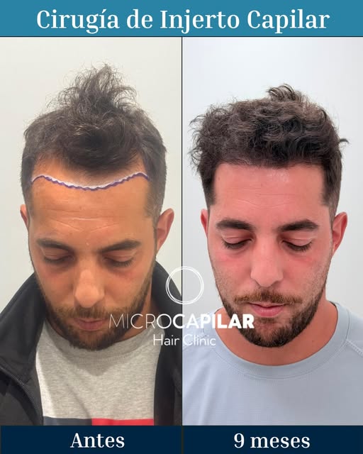 Un cambio muy positivo para una paciente que ahora luce más joven. 

Se trata de una cirugía de inje
