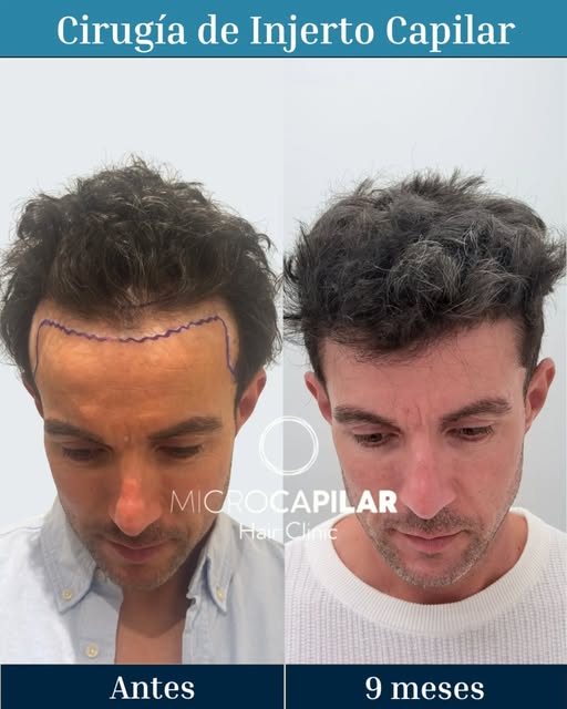 Cirugía de Injerto Capilar de Máxima Extracción Folicular con Técnica FUE Zafiro HD con 9 meses de p