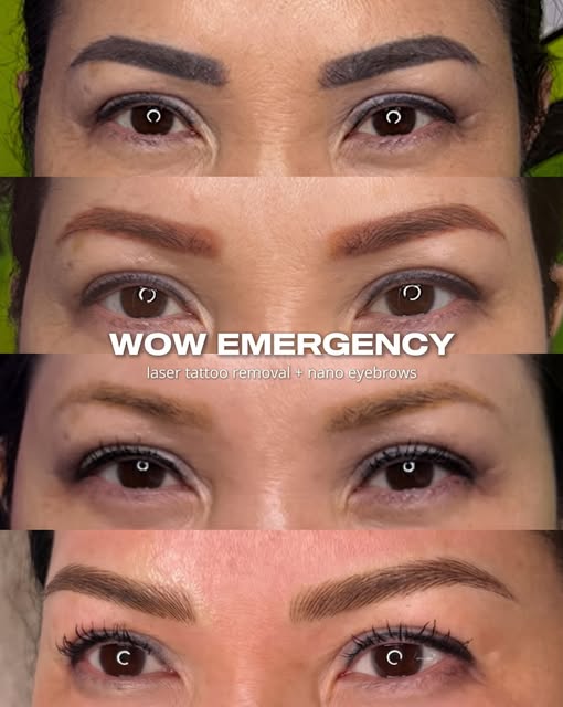 Our «wow» combo! ✨ Laser tattoo removal + new nano brows