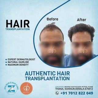 Call 7012822049 for hair transplantation by an expert dermatologist, 
Member of American Hair Resear