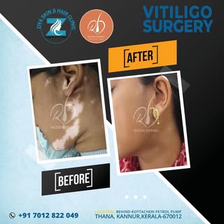 Vitiligo surgery - an effective treatment for refractory white patches in stable vitiligo and post b