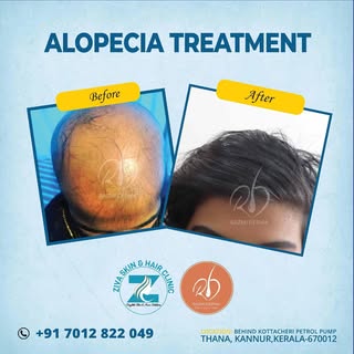 Embrace the newer developments in Alopecia areata treatment to regain your hair and the confidence! 