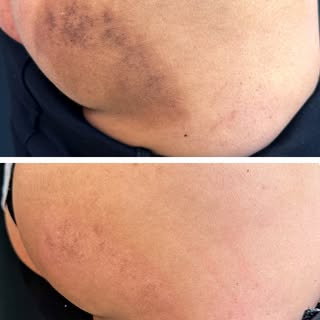 O clareamento desta mancha corporal que você confere na imagem foi alcançado com apenas 3 sessões do
