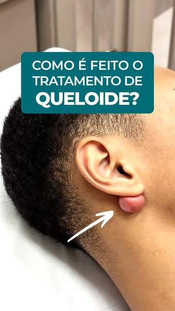 Todo queloide exige uma avaliação médica minuciosa, simplesmente porque cada caso possui particulari