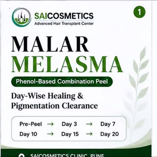 ✨ 15-Year Melasma Transformation | 20-Day Clinical Journey ✨

A 15-year-old stubborn malar melasma t