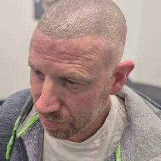 ✨️ NEW POST ✨️ 

CLIENT HAD 2 HAIR TRANSPLANTS WHICH FAILED HIM! SO NOW HE HAS HAD SMP, WHICH HAS DO