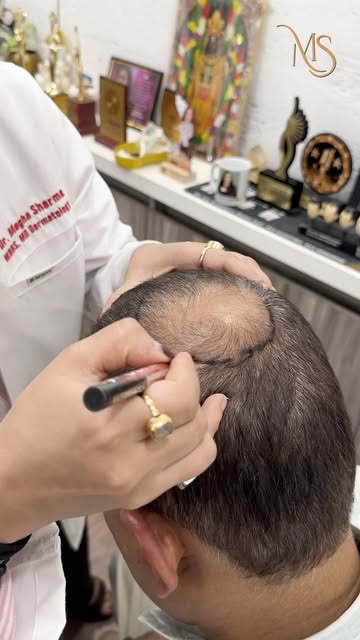 A natural hairline isn’t just about adding hair — it’s about designing the right hairline for YOU. ✨