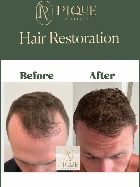 6-month FUE Hair Transplant progress performed by Dr. Saltzburg.

Hair restoration isn’t simply abou