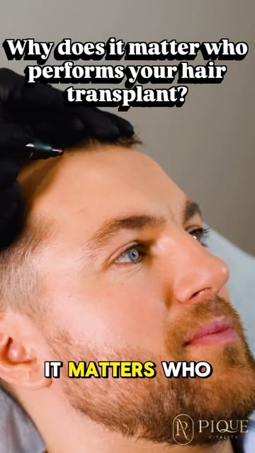 Who performs your Hair Transplant matters ‼️

It’s not just about moving hair from one area to anoth