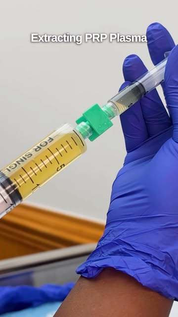Platelet-Rich Plasma (PRP) Scalp
Treatment. Helping support healthier, fuller-looking hair from the 