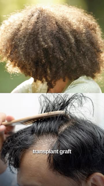 Did you know your hair type can affect the shape of a hair transplant graft?

Straight, wavy, and ti