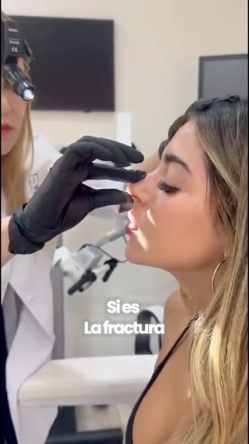 👃🏻 Así es el proceso de una rinoplastia, paso a paso.

Hoy os enseñamos el caso de una paciente de