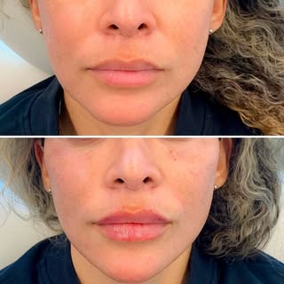 Journey of the  1ml Lip Filler Treatment 🤩

👄Treatment: Lip Augmentation 
✔️Instant and Natural Re