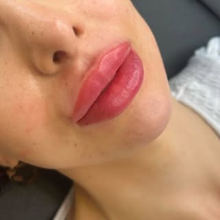 1 month ago we did natural lip colouring and today lip filling was done on it. The lips are a little