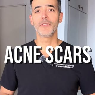 If you're struggling with acne scars, listen up! There are many treatments available to help with ac