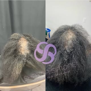Look at this progress!. ⁣⁣⁣⁣
🚫No Rogaine⁣⁣⁣⁣
🚫No Minoxidil ⁣⁣⁣⁣
🚫No Injections ⁣⁣⁣⁣
⁣⁣⁣⁣
If you a
