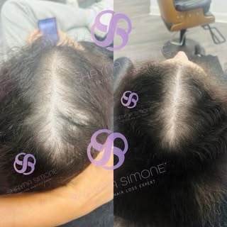 From thinning to TRANSFORMATION ✨
Androgenic alopecia does not have to define your story. With consi