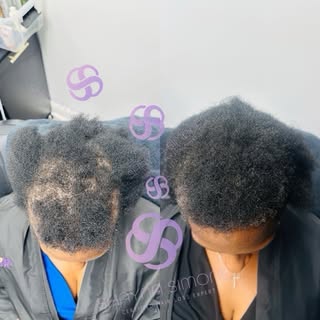 7 Weeks. No Rogaine. No Minoxidil. No Steroids.

These photos brought me to tears.

In just 7 weeks,