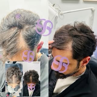 5 Week Results. Let that sink in. 👏

This client came to me struggling with male pattern hair loss,