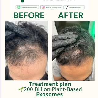 🌱 Visible progress in just 3.5–4 months

This client has been following a treatment plan combining 