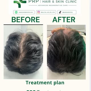 PRF Hair Restoration — Progress After 3 Sessions

Another encouraging result following a course of 3