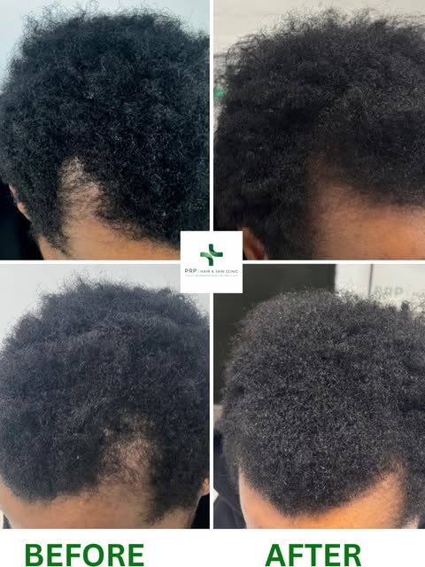 Alopecia — visible progress with PRP hair restoration.

This client presented with areas of hair los
