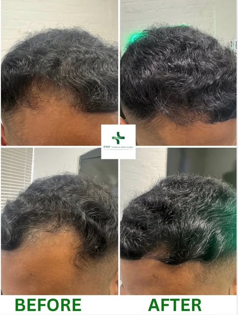 Visible progress. Realistic expectations. 👏

This client has been undergoing a course of PRF hair r