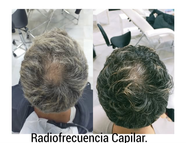 ¿Haces algo para frenar la caída del cabello? Si quieres comenzar a hacerlo, desde ReVival te recome